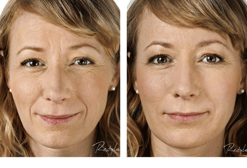 the effects of Restylane