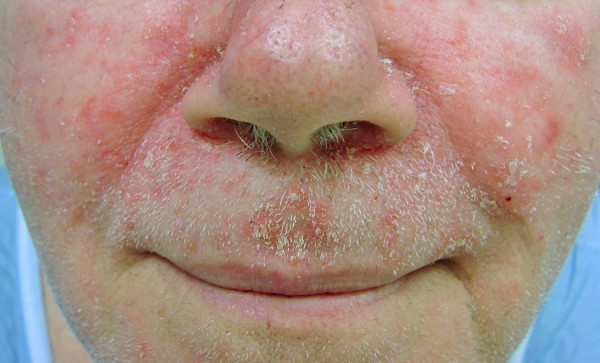 reddened skin around a man's mouth and nose