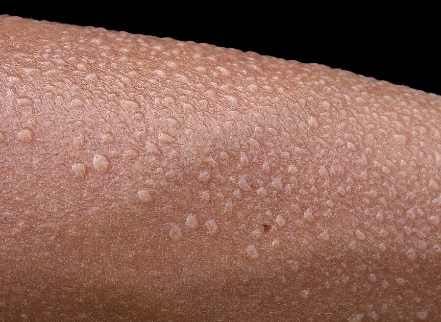 heat rash treatment close up