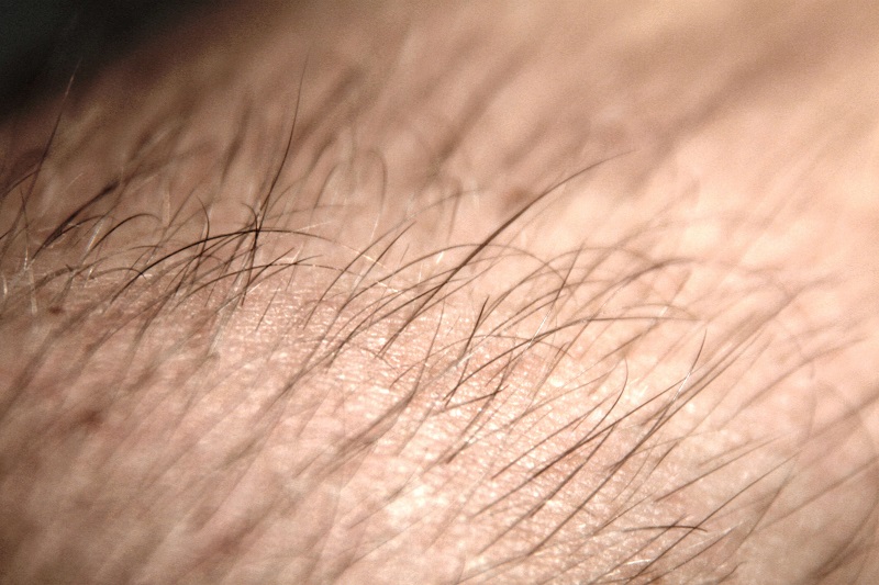 IPL hair removal side effects