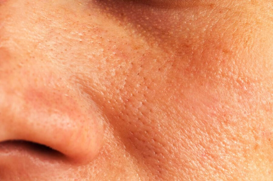close up of face with inflamed pores and oiliness