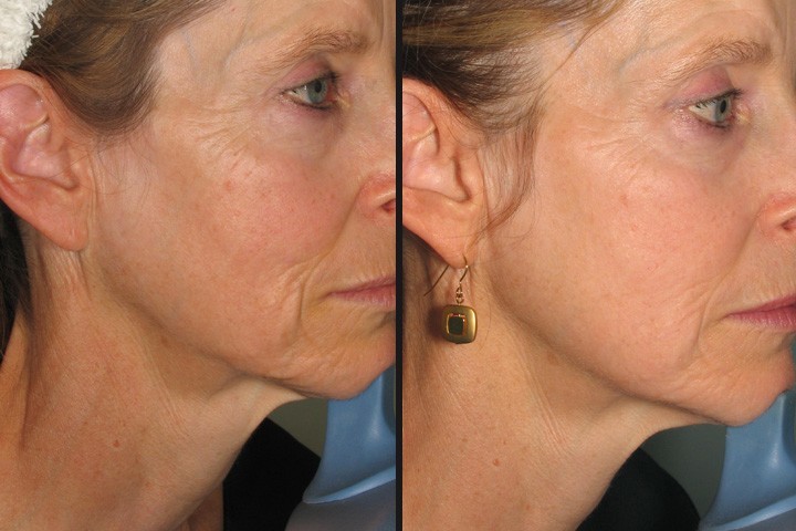 effects of a skin tightening treatment
