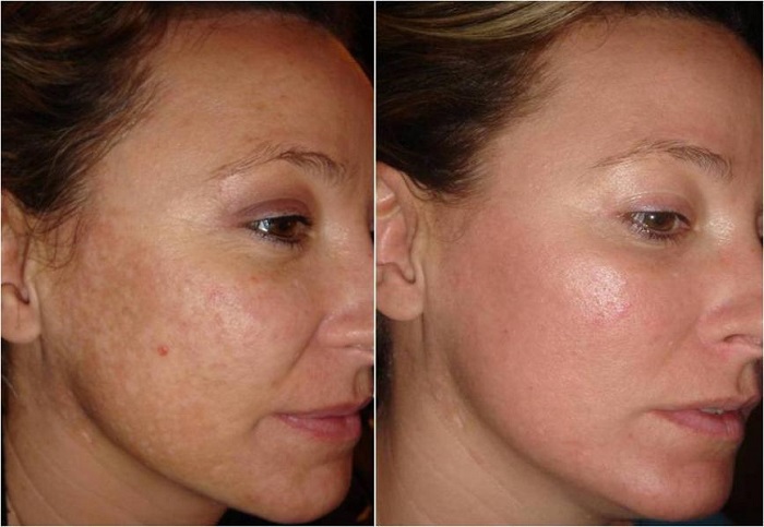Fractional Laser Resurfacing skin treatment