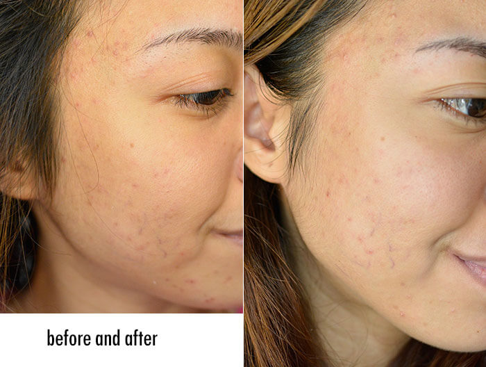 before and after using a skin lightening cream with kojic acid