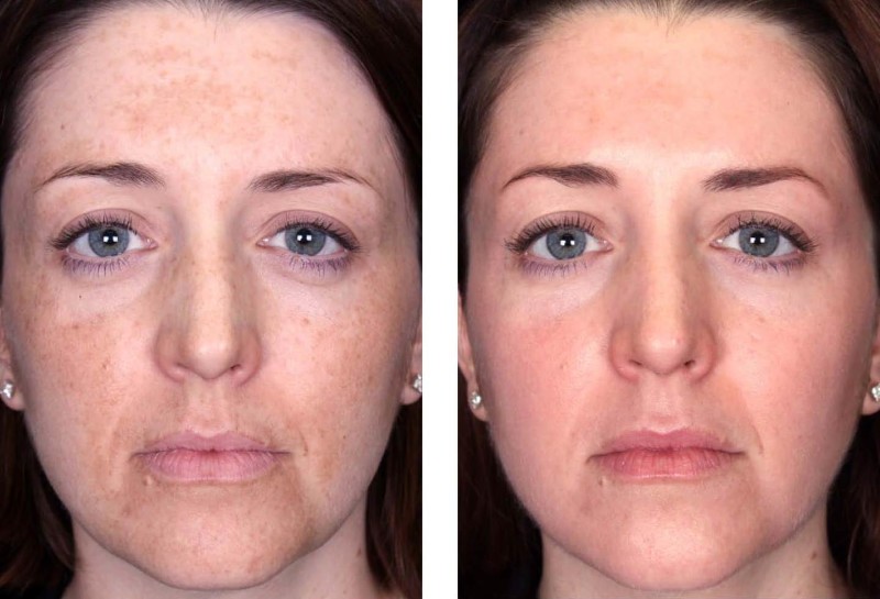 woman's face skin before and after a chemical peel