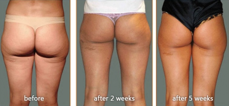 Carboxytherapy for Cellulite before and after