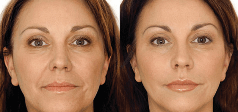 before and after pictures of the effects of facial acupuncture