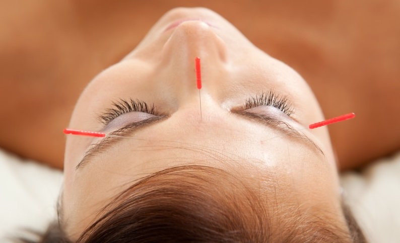 woman with acupuncture needles stuck on her face