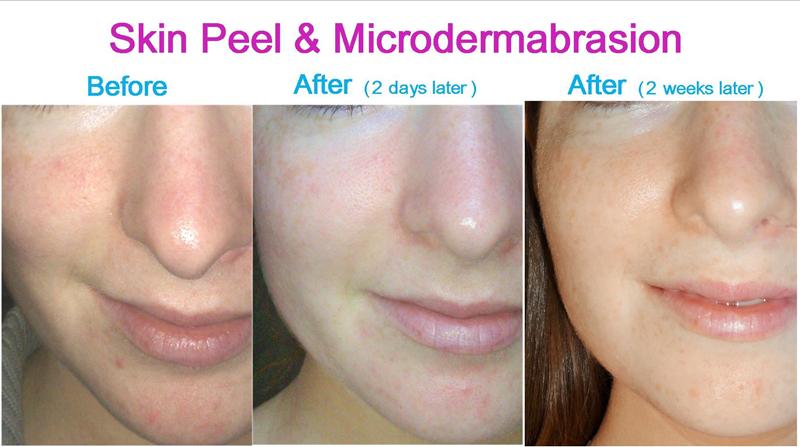The results of skin peel and microdermabrasion