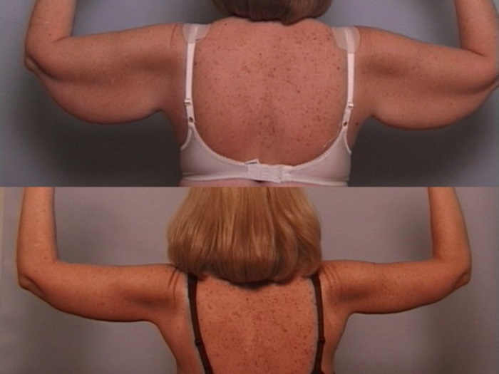 arm lift, one of the best answers to how to tighten loose skin after weight loss