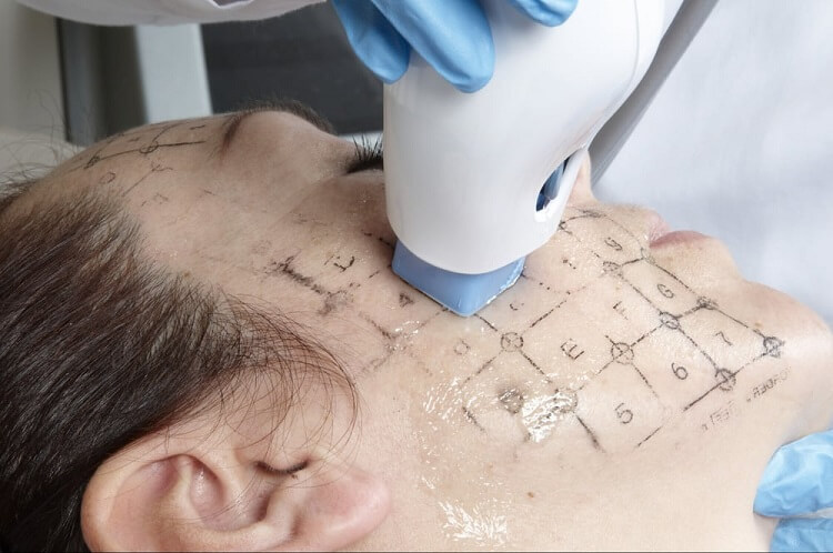 woman receiving thermage skin tightening treatment