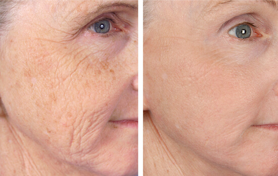 Non-ablative laser resurfacing before and after