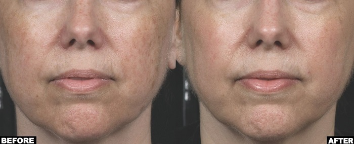 Before and After Non Ablative Laser Resurfacing