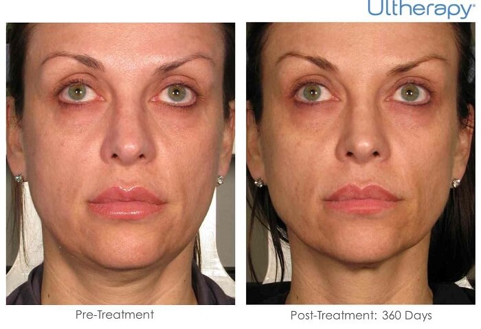 Ultherapy before and after pictures